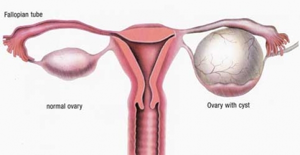 imagini/poza tumorile ovariene